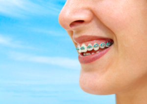 braces for adults in cheyenne wy